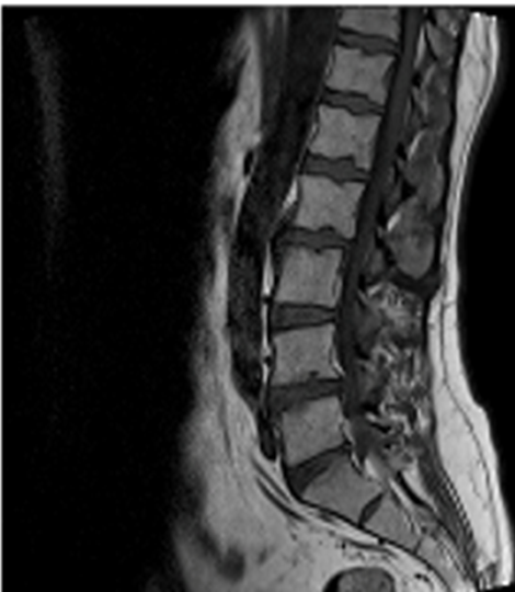 Original sagittal lumbar MRI image before analysis