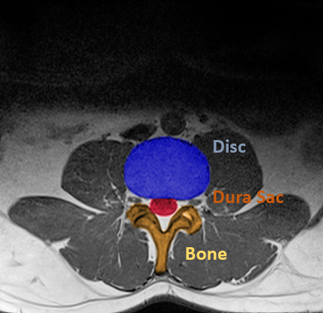 RadiSpine axial MRI structure segmentation example