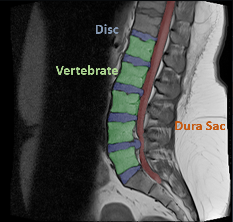 RadiSpine sagittal MRI structure segmentation example